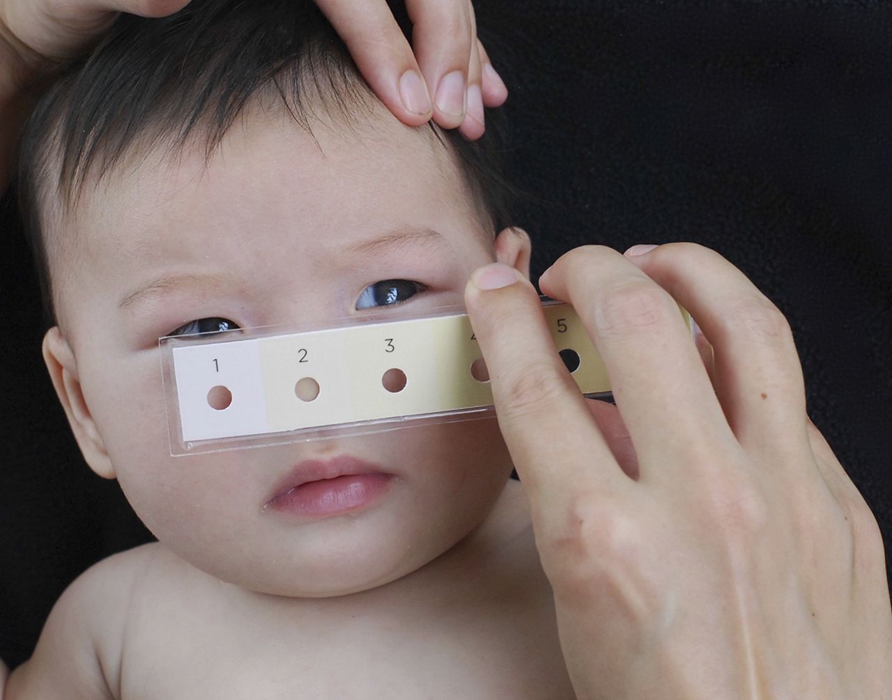  Use of the Bili-ruler on the nose of an infant at BWH in Boston. ©pediatrics